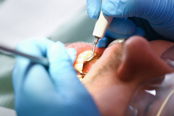 Best Emergency Wisdom Teeth Removal in Dumont, NJ